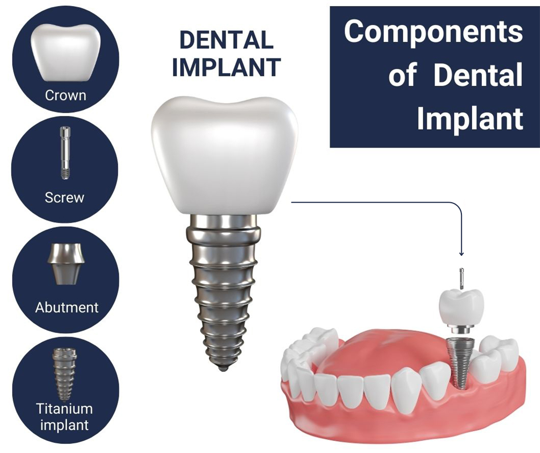 Dental-Implant-Components-Info