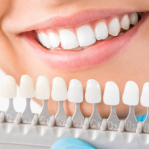 Do-Porcelain-Veneers-Cost