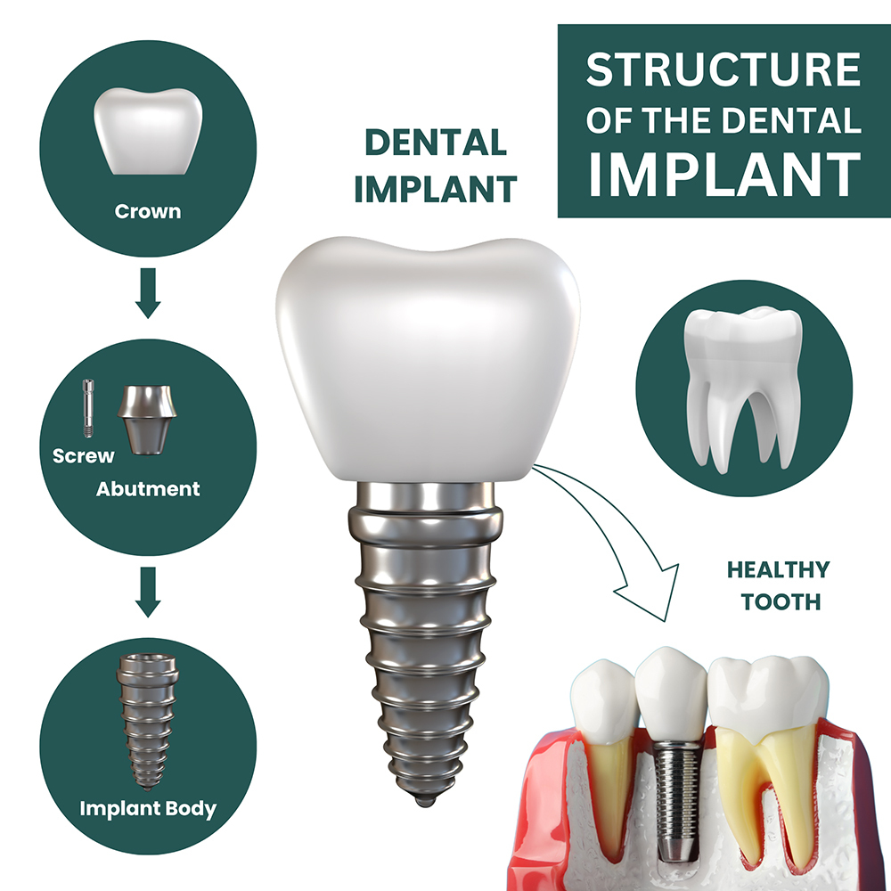 dental-implant-structure